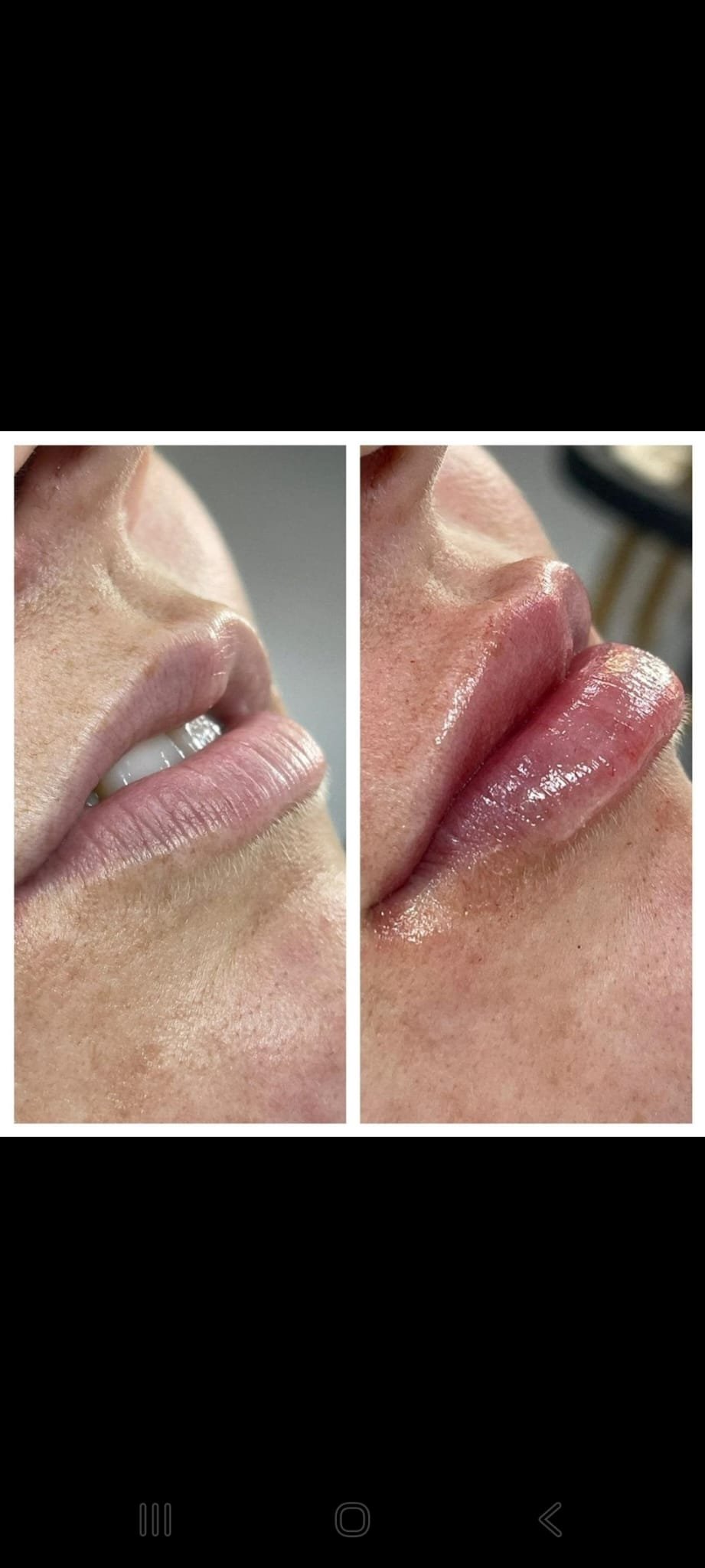 Lip Filler Before & After